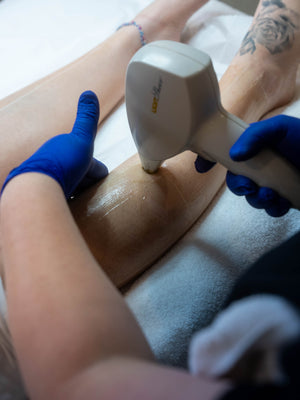 Guide complet de l'épilation au laser : Ce que vous devez savoir